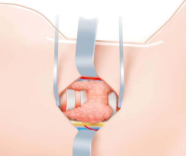 Thyroid Surgery Step 5 Exposure of the thyroid